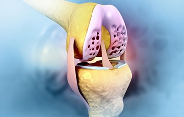 Is Cartilage Restoration Right for You? A Guide to Preserving Your Joints Without Replacem...