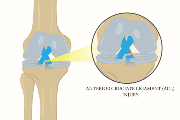 How BEAR® Technology Supports Natural ACL Healing and Better Cartilage Preservation