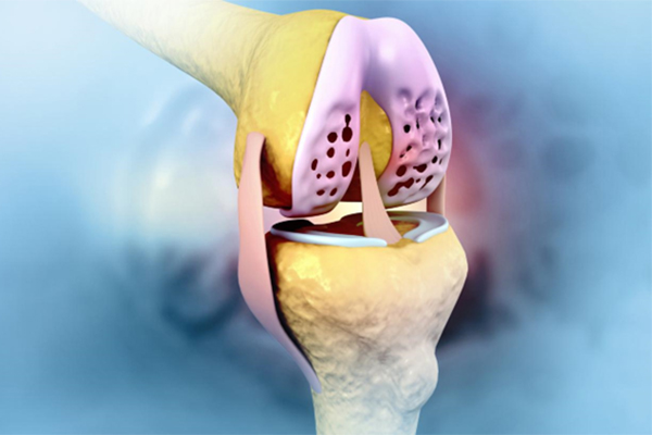 Is Cartilage Restoration Right for You? A Guide to Preserving Your Joints Without Replacement Surgery