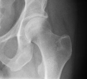Reduce Hip Pain - Joint Relief Tips