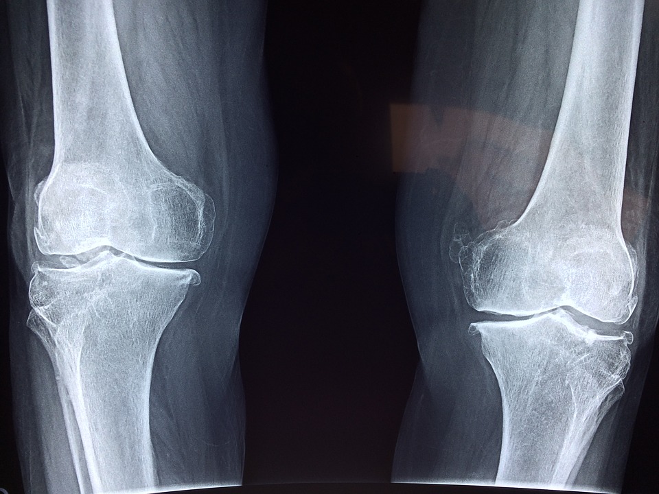 Knee Surgery Comparison?